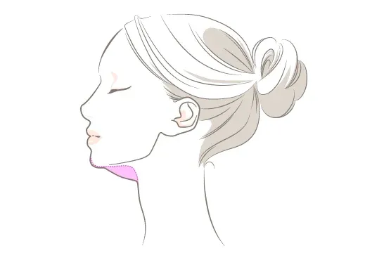 ダウンタイムの少なさが魅力：アポロン式小顔脂肪吸引とは？