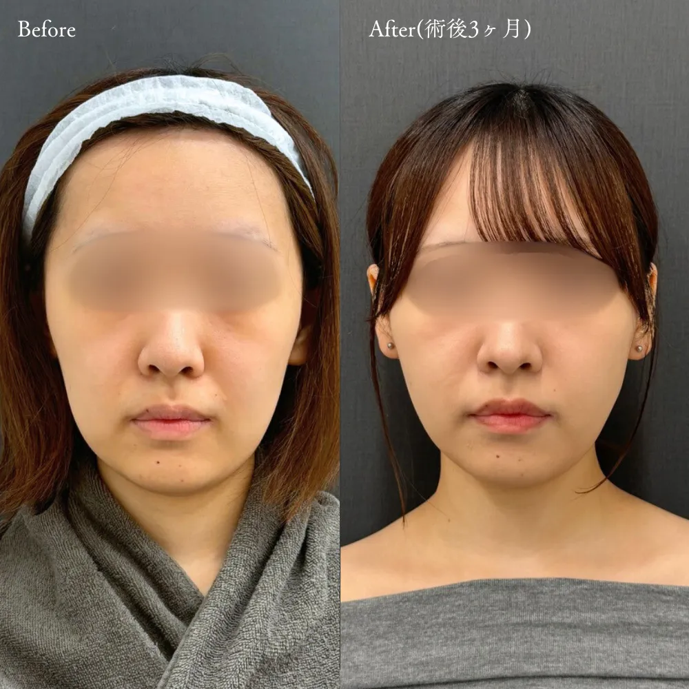 アポロン式小顔脂肪吸引の症例画像（20代・女性）