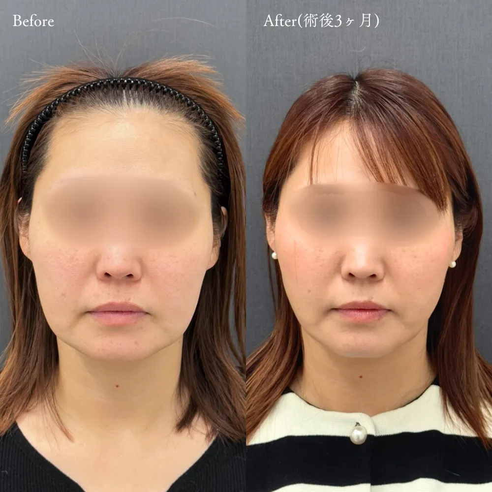 アポロン式小顔脂肪吸引の症例画像（40代・女性）