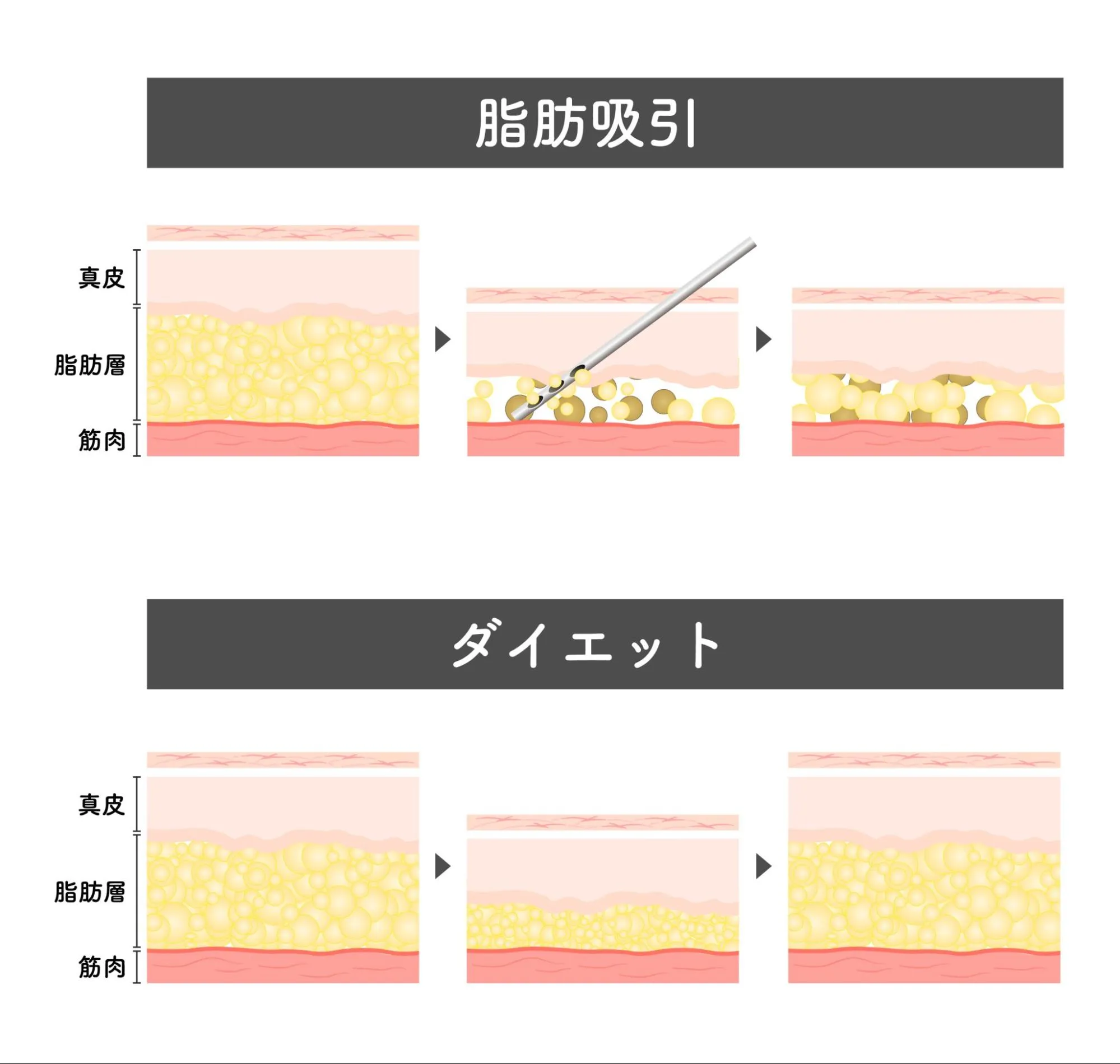 確実な脂肪減少効果 