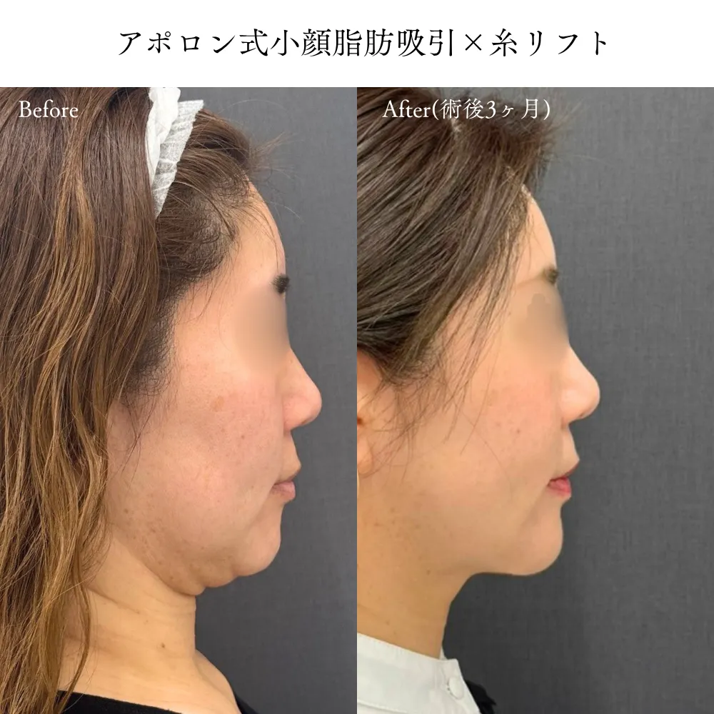 施術後の仕上げやメンテナンスとしての高周波・HIFU