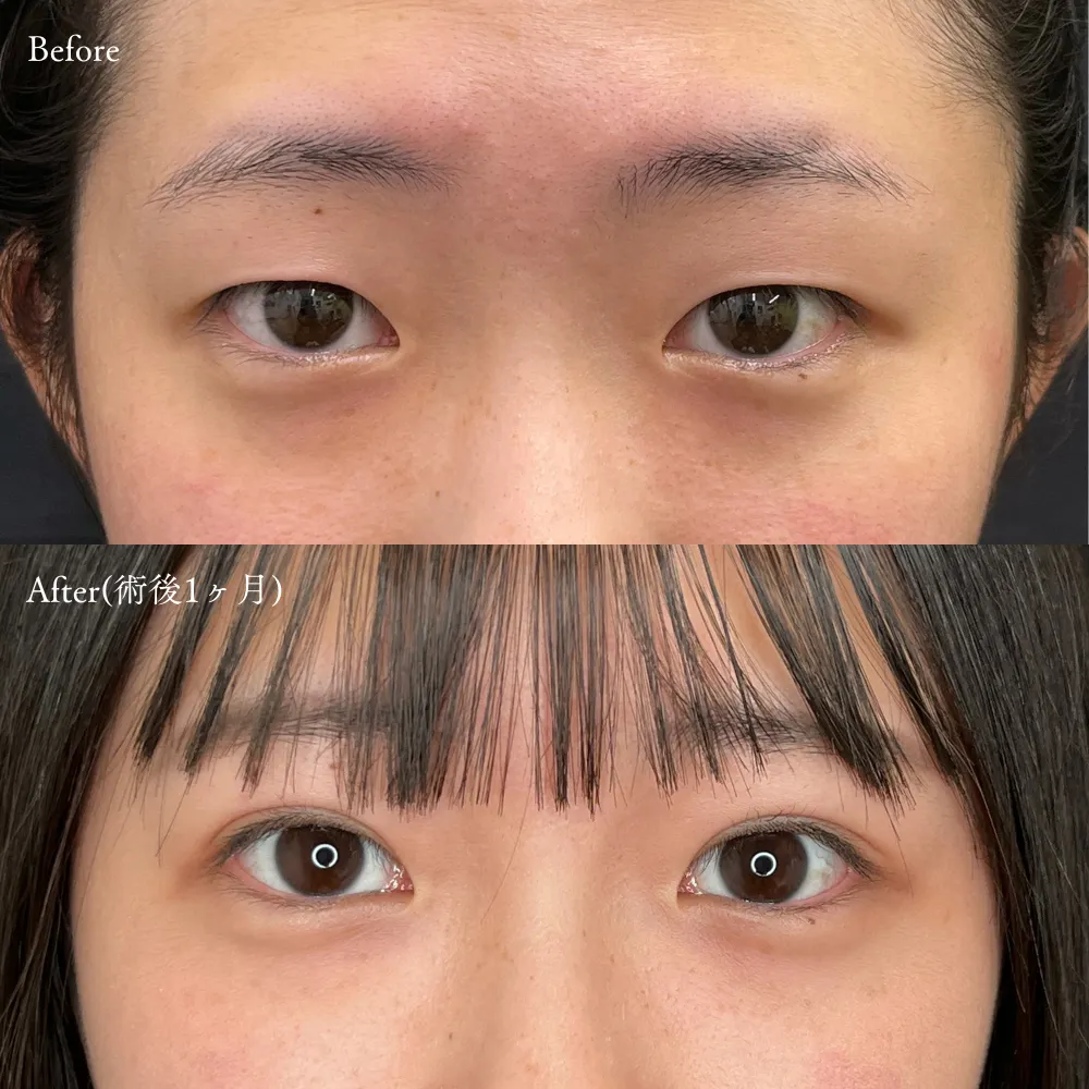 二重埋没法(アポロンアイズ法)の症例画像（10代・女性）
