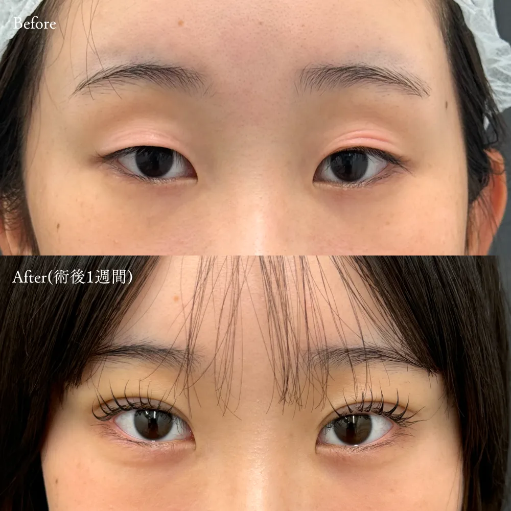 二重埋没法(アポロンアイズ法)の症例画像（10代・女性）