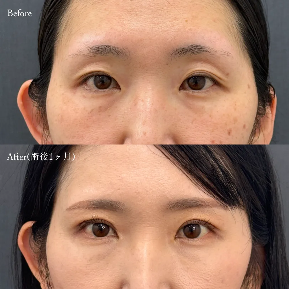 二重埋没法(アポロンアイズ法)の症例画像（30代・女性）
