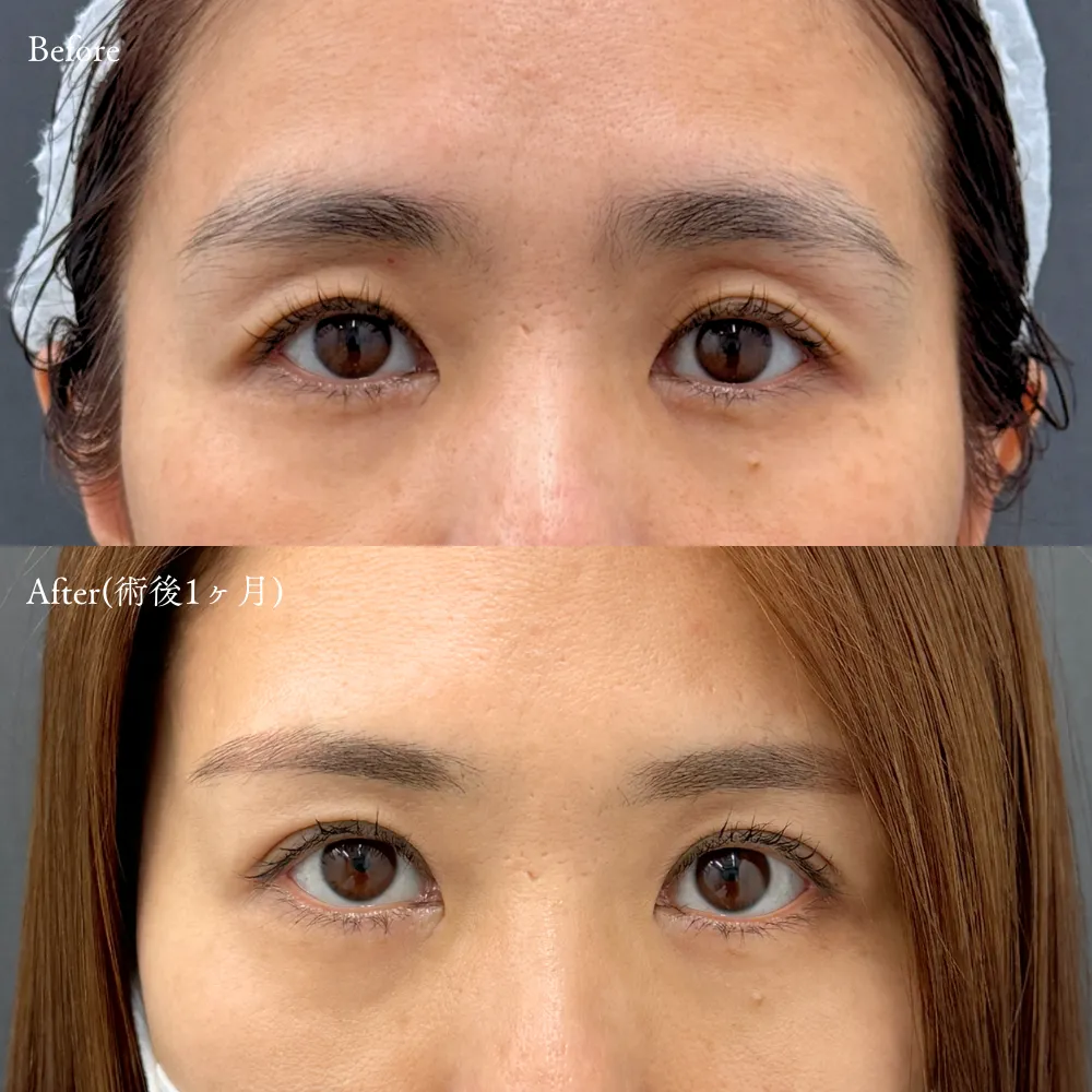 二重埋没法(アポロンアイズ法)の症例画像（30代・女性）