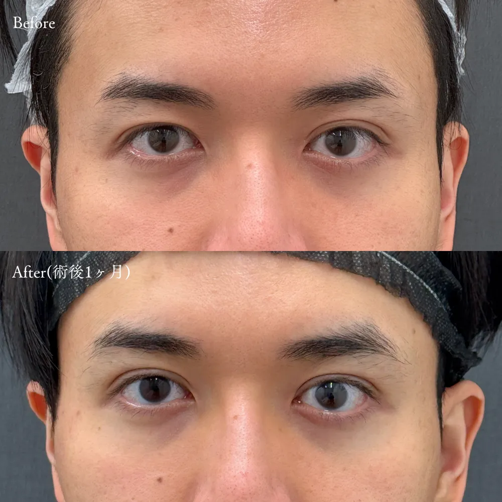 二重埋没法(アポロンアイズ法)の症例画像（30代・男性）
