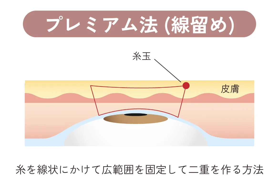 プレミアム法