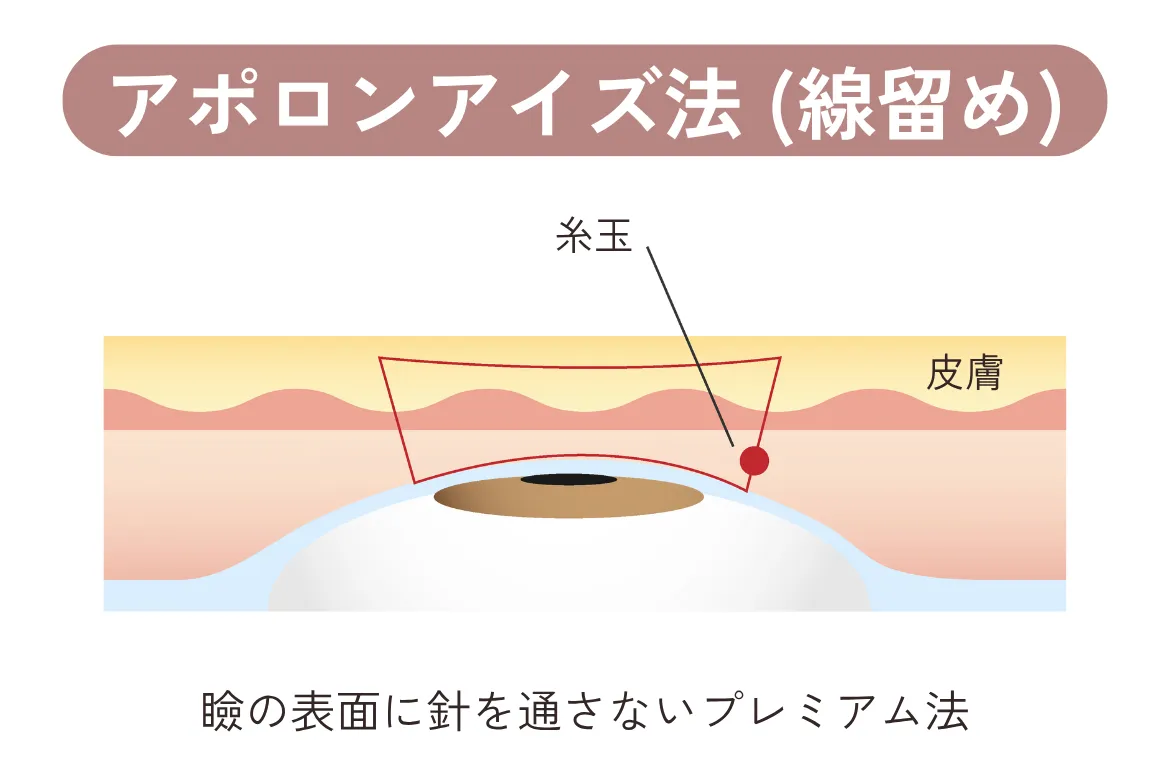 アポロンアイズ法