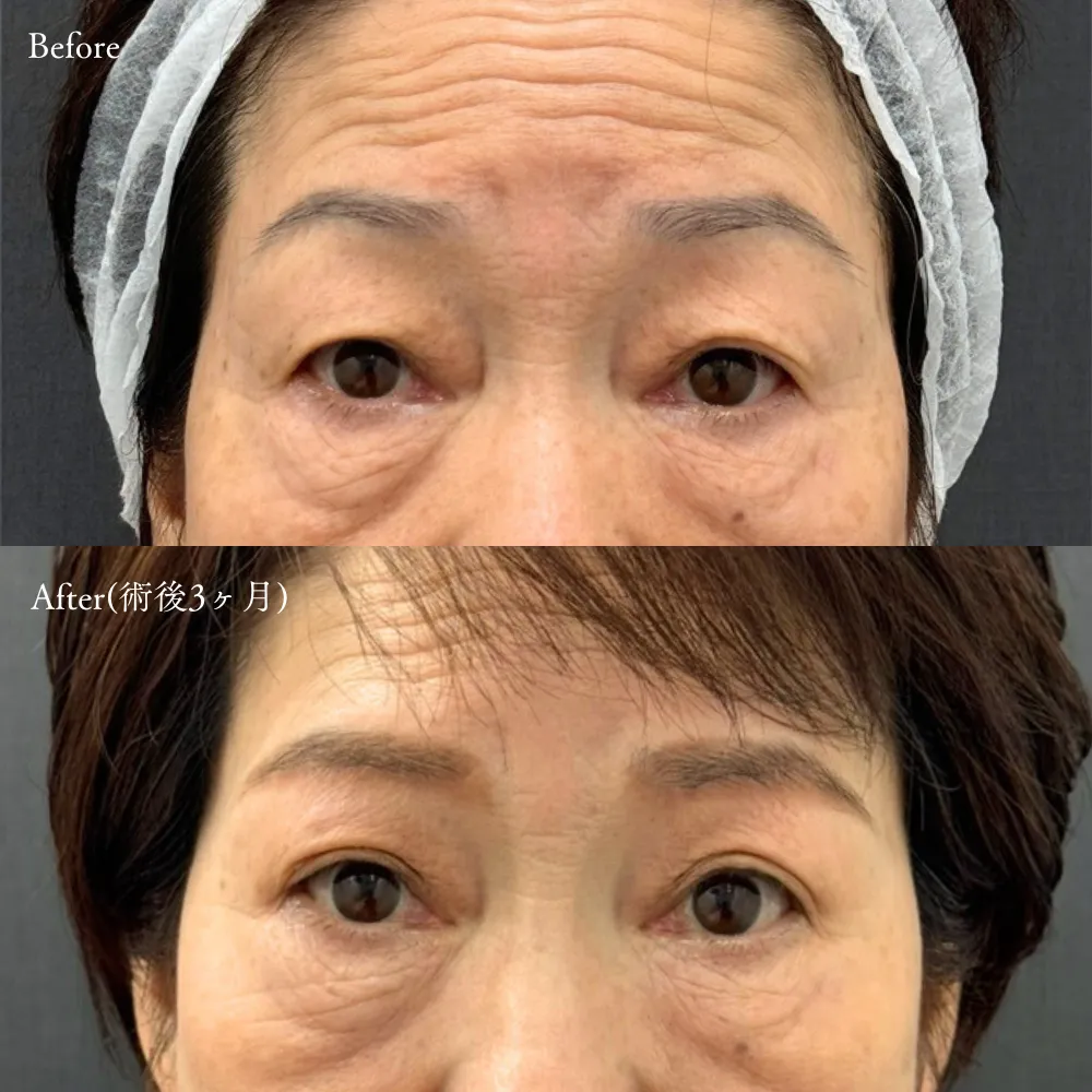 眉下切開の症例画像（60代・女性）