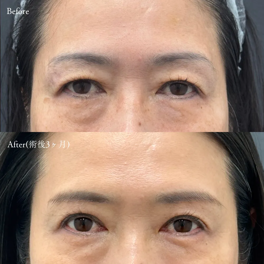 眉下切開の症例画像（50代・女性）