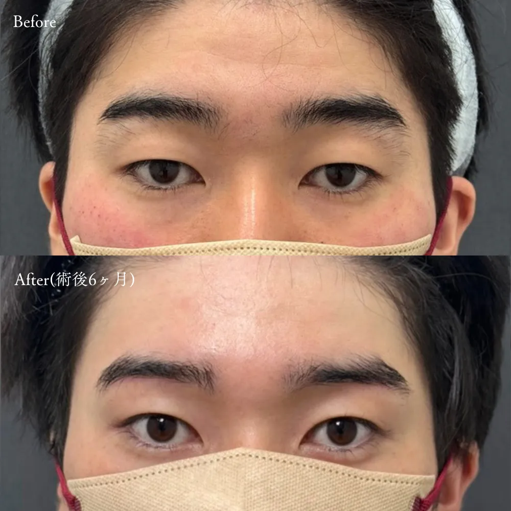 眉下切開の症例画像（20代・女性）