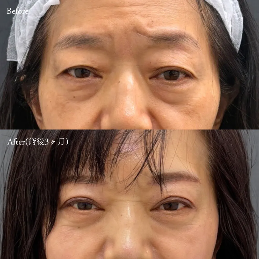 二重埋没法