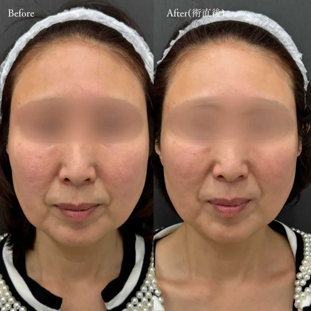 デンシティの症例（50代・女性）