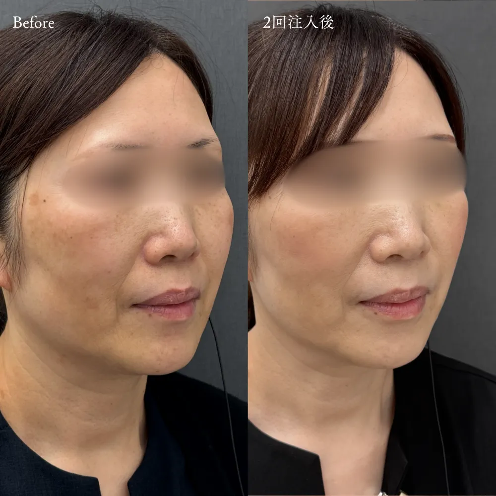 【ジャルプロスーパーハイドロ】の症例画像（50代・女性）