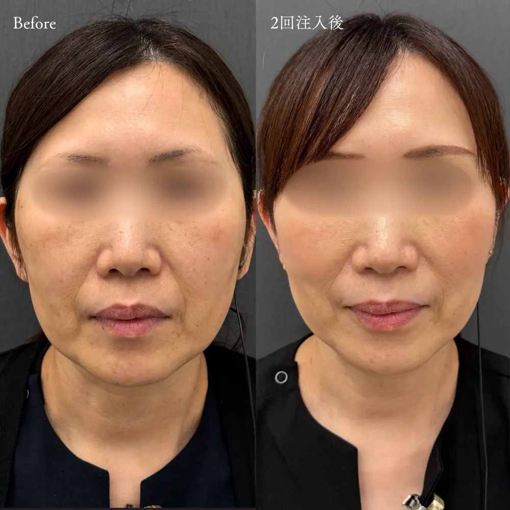 【ジャルプロスーパーハイドロ】の症例画像（50代・女性）