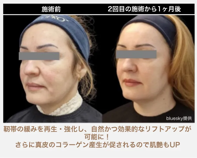 【ジャルプロスーパーハイドロ】の症例画像（50代・女性）