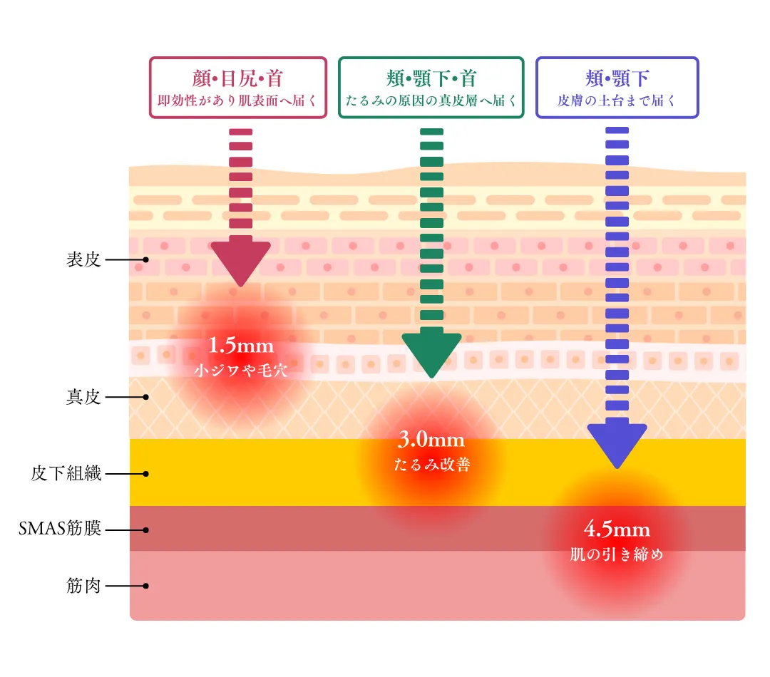 HIFU（ハイフ）とは