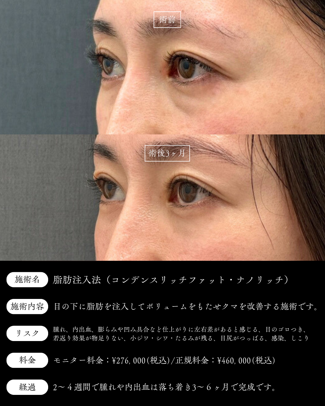 【症例写真】経結膜脱脂術+脂肪注入法(コンデンスリッチ•ナノリッチ)