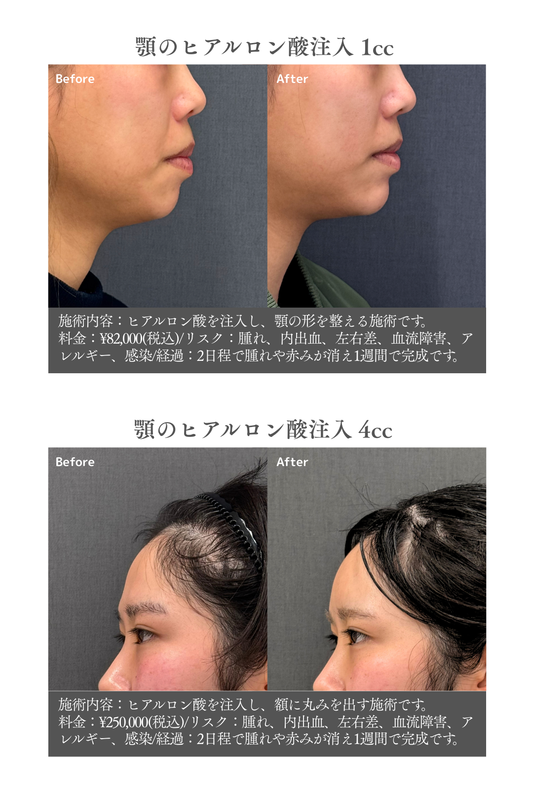 【1周年記念企画】アポロン式カスタマイズ注入で自然で若々しい仕上がりへ 今だけヒアルロン酸1cc¥55,000！
