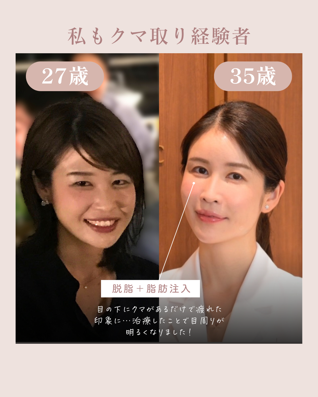 【1周年感謝企画】老け顔に見える原因にさよなら！あなたに合わせたオーダーメイドクマ取りが最大30%OFF（6月1日〜7月31日までの期間限定）