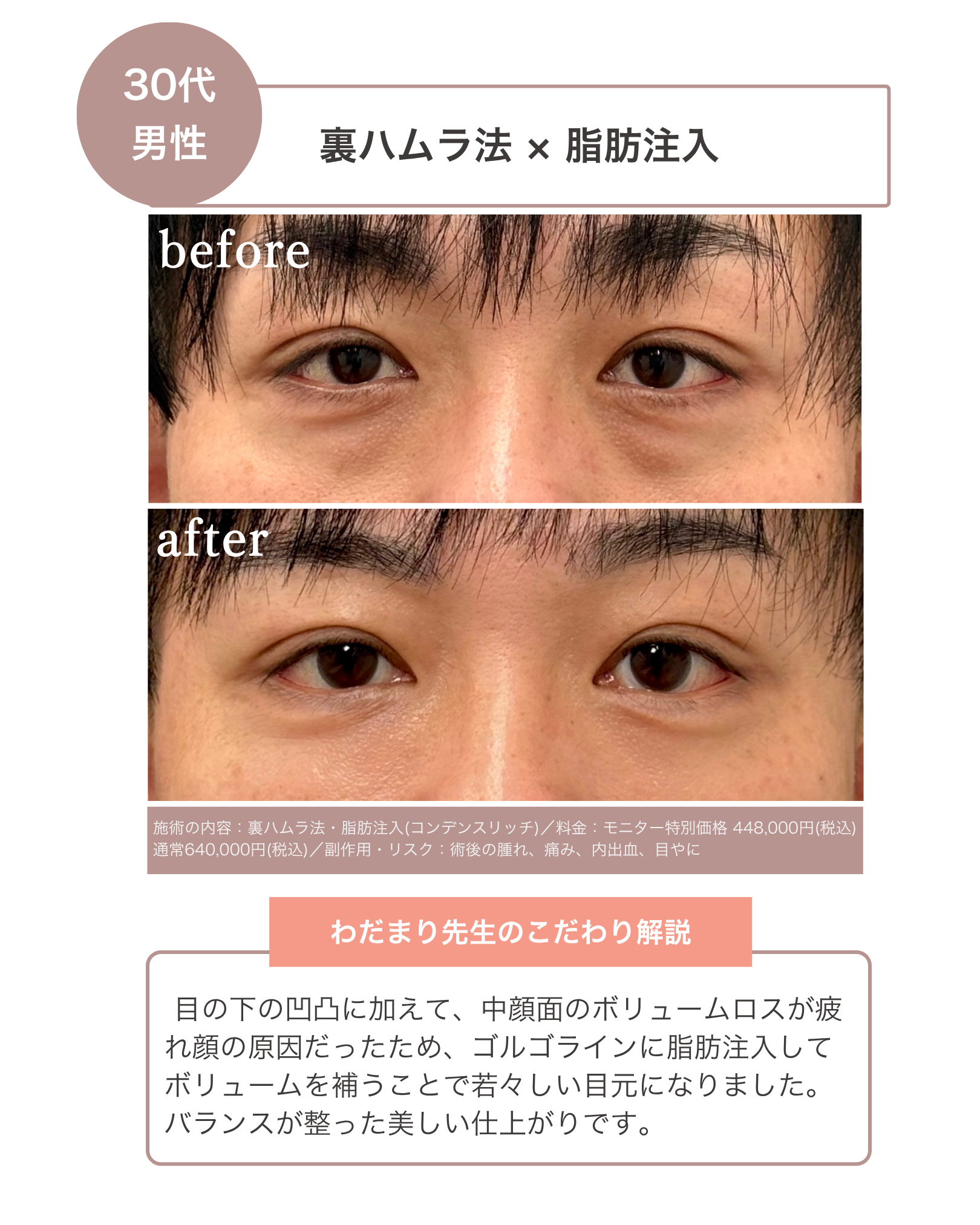 【1周年感謝企画】老け顔に見える原因にさよなら！あなたに合わせたオーダーメイドクマ取りが最大30%OFF（6月1日〜7月31日までの期間限定）