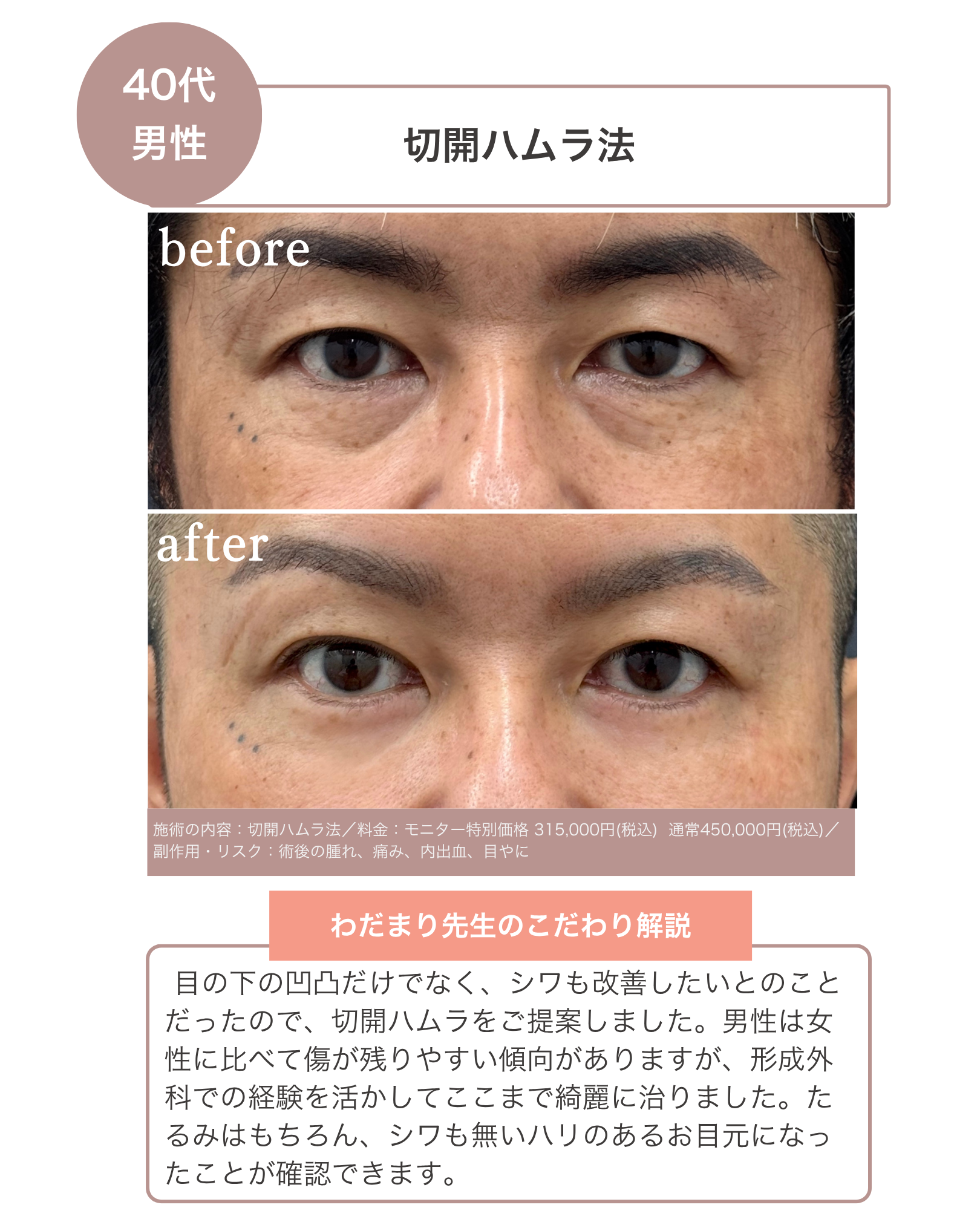 【1周年感謝企画】老け顔に見える原因にさよなら！あなたに合わせたオーダーメイドクマ取りが最大30%OFF（6月1日〜7月31日までの期間限定）