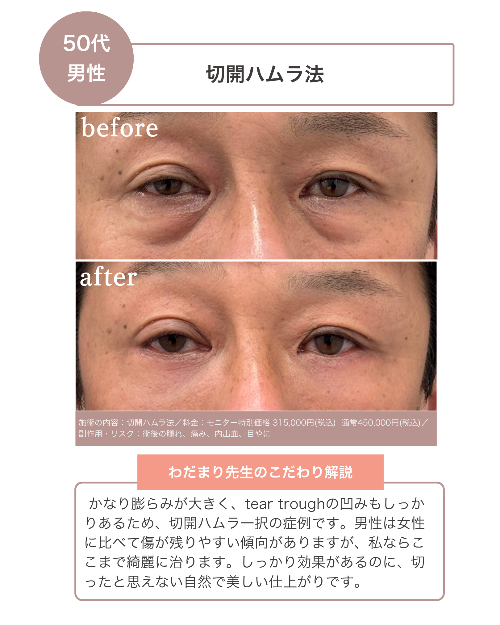 【1周年感謝企画】老け顔に見える原因にさよなら！あなたに合わせたオーダーメイドクマ取りが最大30%OFF（6月1日〜7月31日までの期間限定）