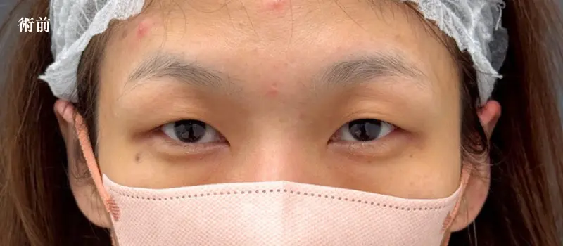 二重埋没ダウンタイム完全ガイド！症状経過と6つの賢い過ごし方