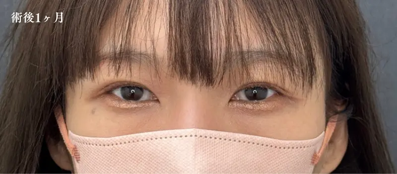 二重埋没ダウンタイム完全ガイド！症状経過と6つの賢い過ごし方