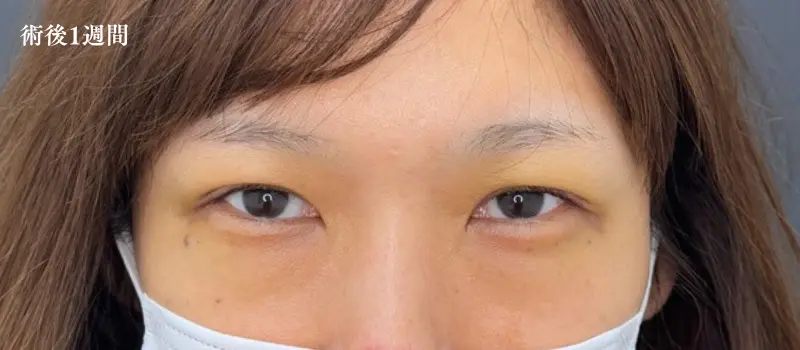 二重埋没ダウンタイム完全ガイド！症状経過と6つの賢い過ごし方
