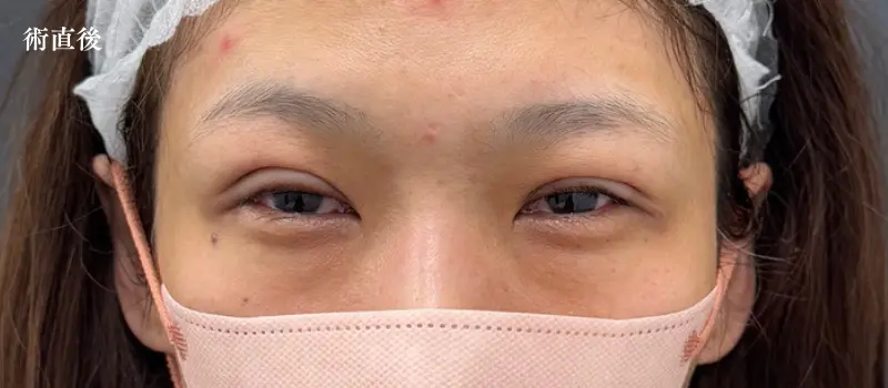 二重埋没ダウンタイム完全ガイド！症状経過と6つの賢い過ごし方