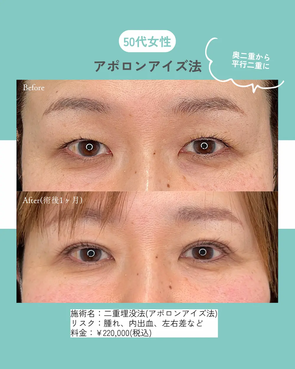 二重整形や目頭切開などの目元整形が最大40%OFF！長期休みを利用して『目元垢抜け』しませんか？（8月31日までの期間限定）