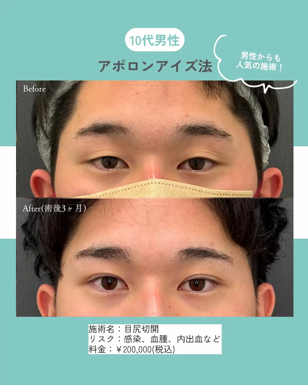 二重整形や目頭切開などの目元整形が最大40%OFF！長期休みを利用して『目元垢抜け』しませんか？（8月31日までの期間限定）