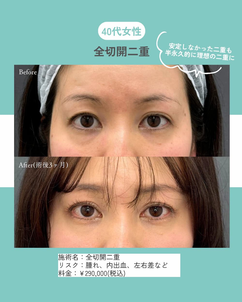 二重整形や目頭切開などの目元整形が最大40%OFF！長期休みを利用して『目元垢抜け』しませんか？（8月31日までの期間限定）