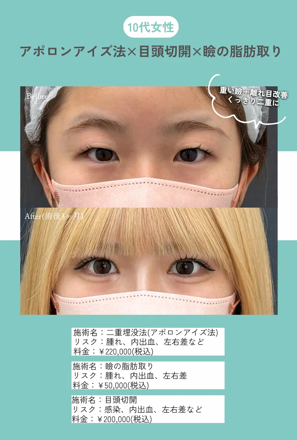 二重整形や目頭切開などの目元整形が最大40%OFF！長期休みを利用して『目元垢抜け』しませんか？（8月31日までの期間限定）