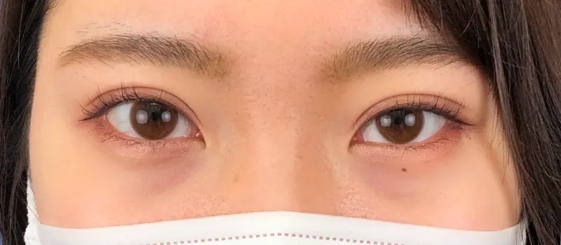 平行二重は日本人には似合わない？憧れの平行二重になりたいあなたへ