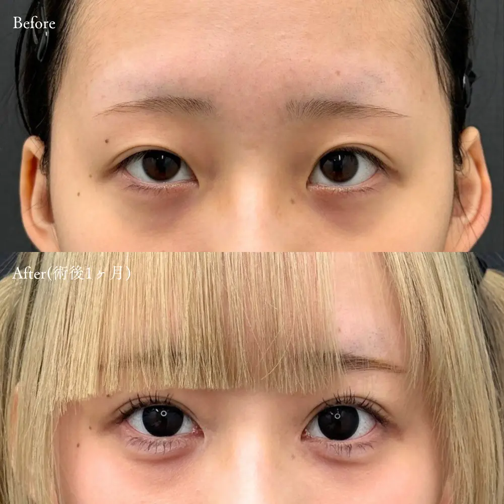 平行二重は日本人には似合わない？憧れの平行二重になりたいあなたへ