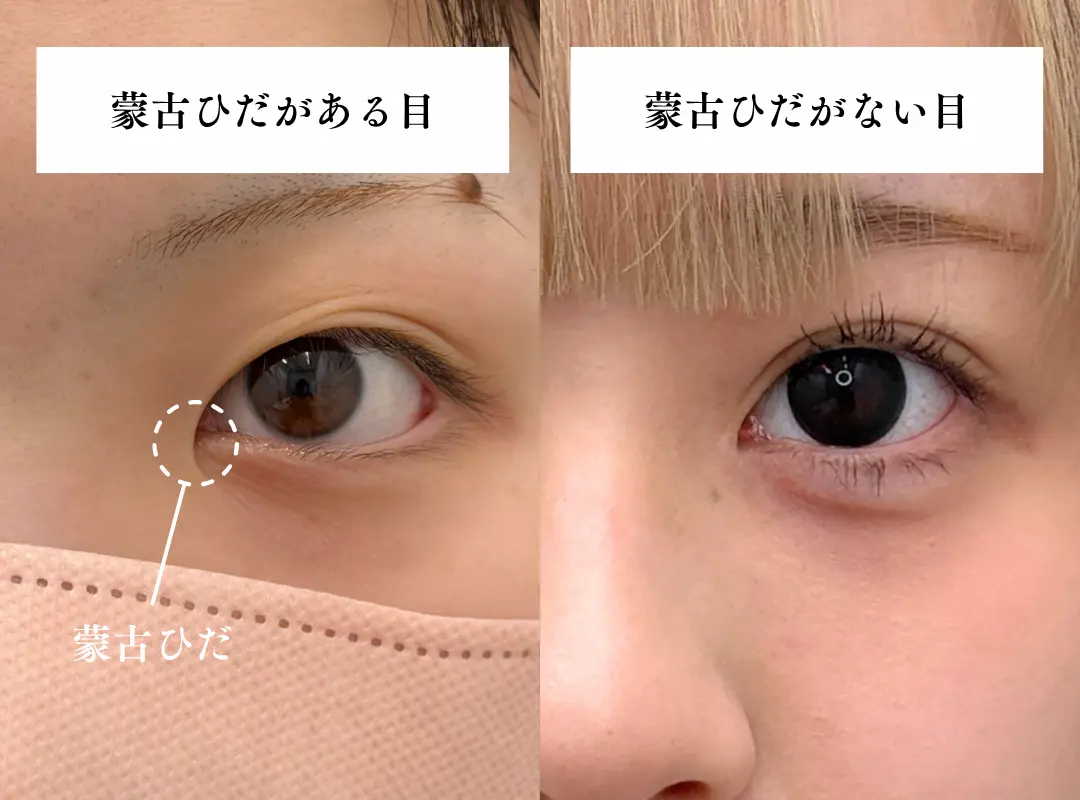平行二重は日本人には似合わない？憧れの平行二重になりたいあなたへ