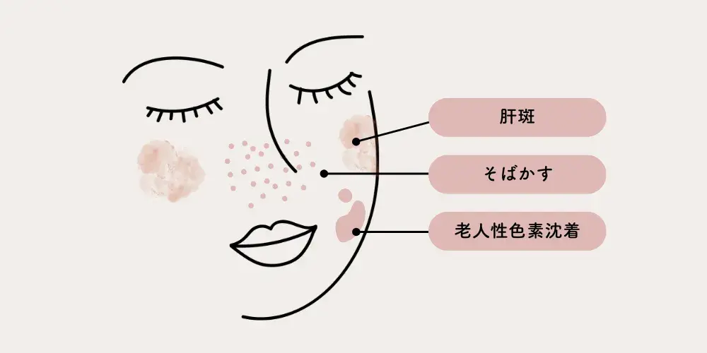 シミの種類とその特徴