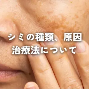 シミの種類、原因、治療法について