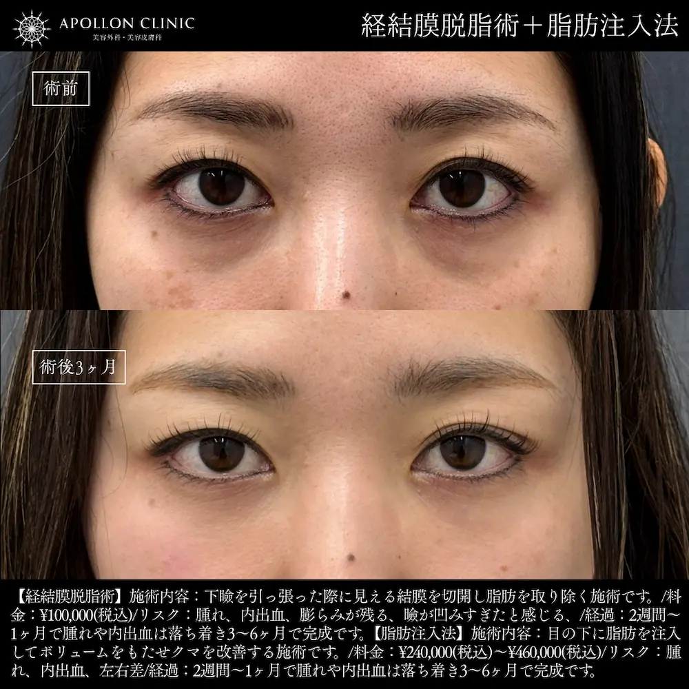 経結膜脱脂術+脂肪注入法 女性 術前と術後3ヶ月の症例写真