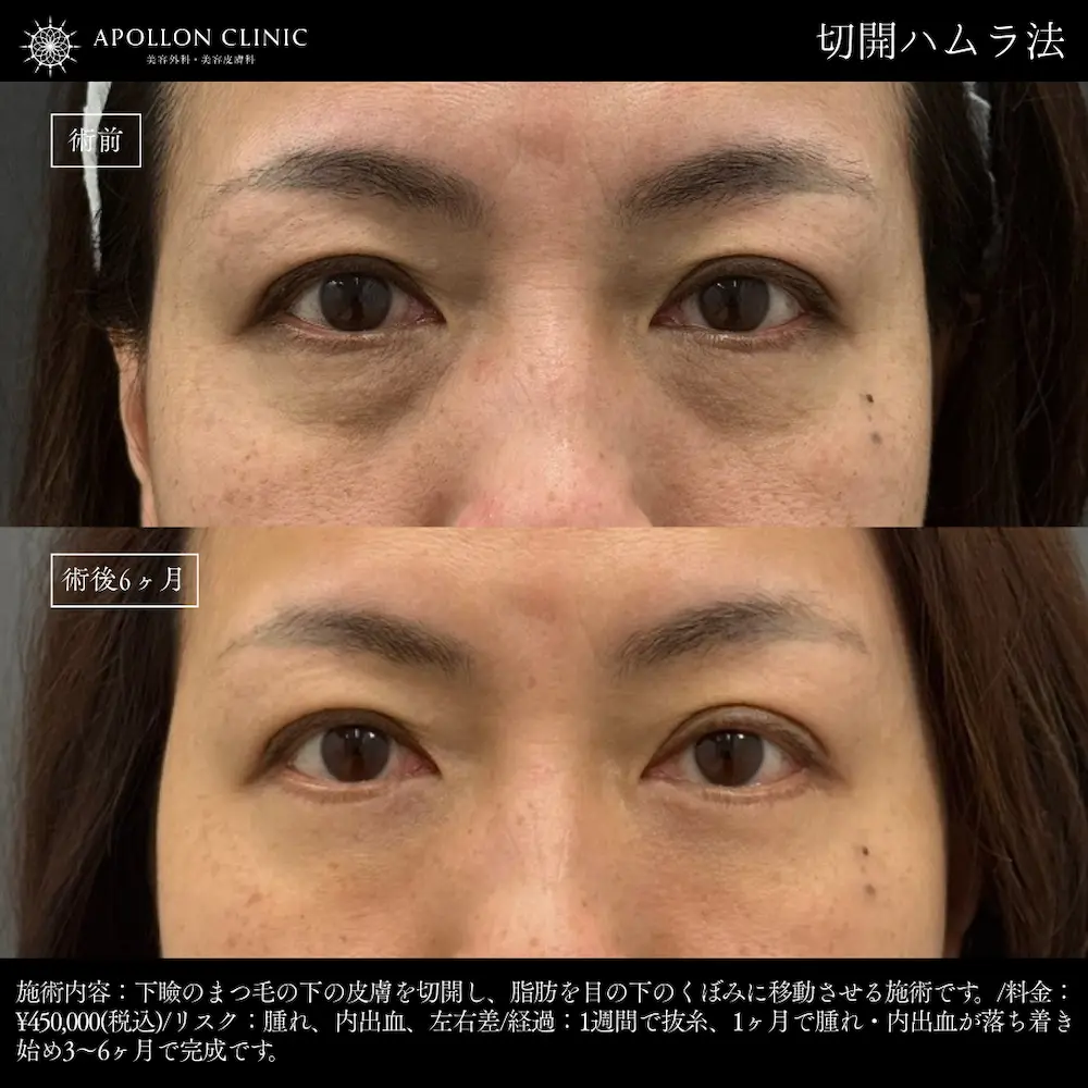 切開ハムラ法 女性 術前と術後6ヶ月の症例写真