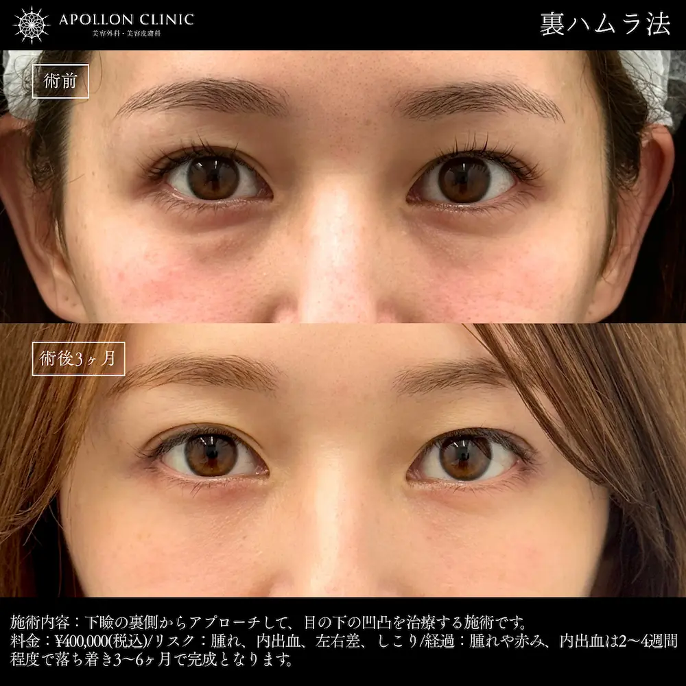 裏ハムラ法 女性 術前と術後3ヶ月の症例写真