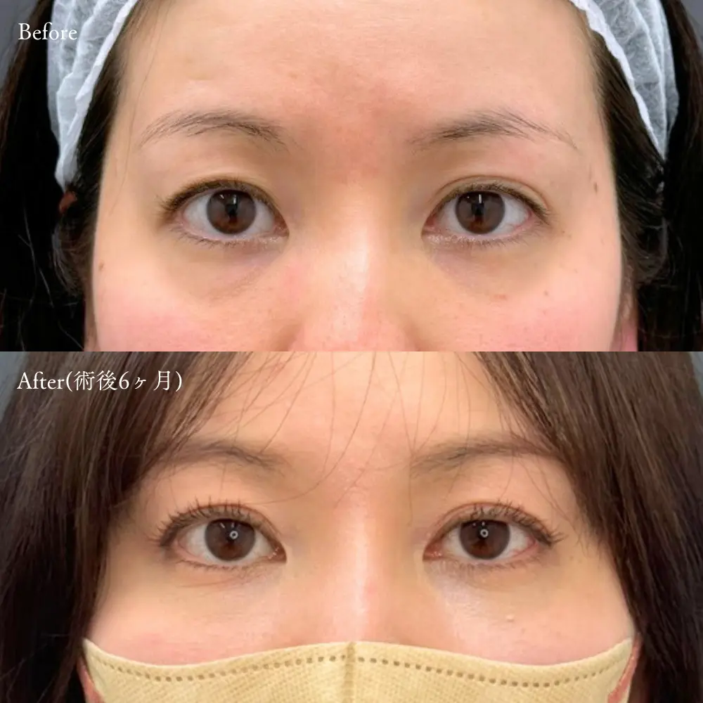 切開法の症例写真(術前・術後6ヶ月)