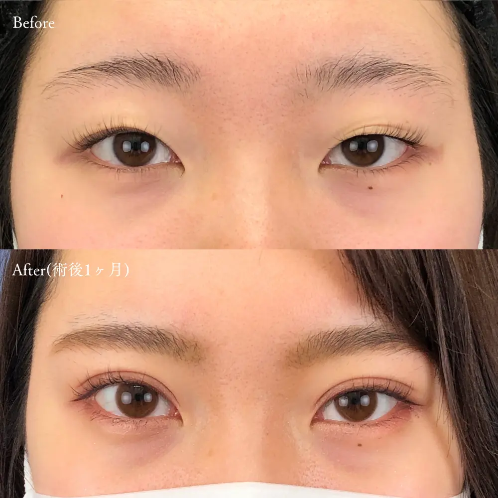 二重埋没法の症例写真(女性 術前・術後1ヶ月)