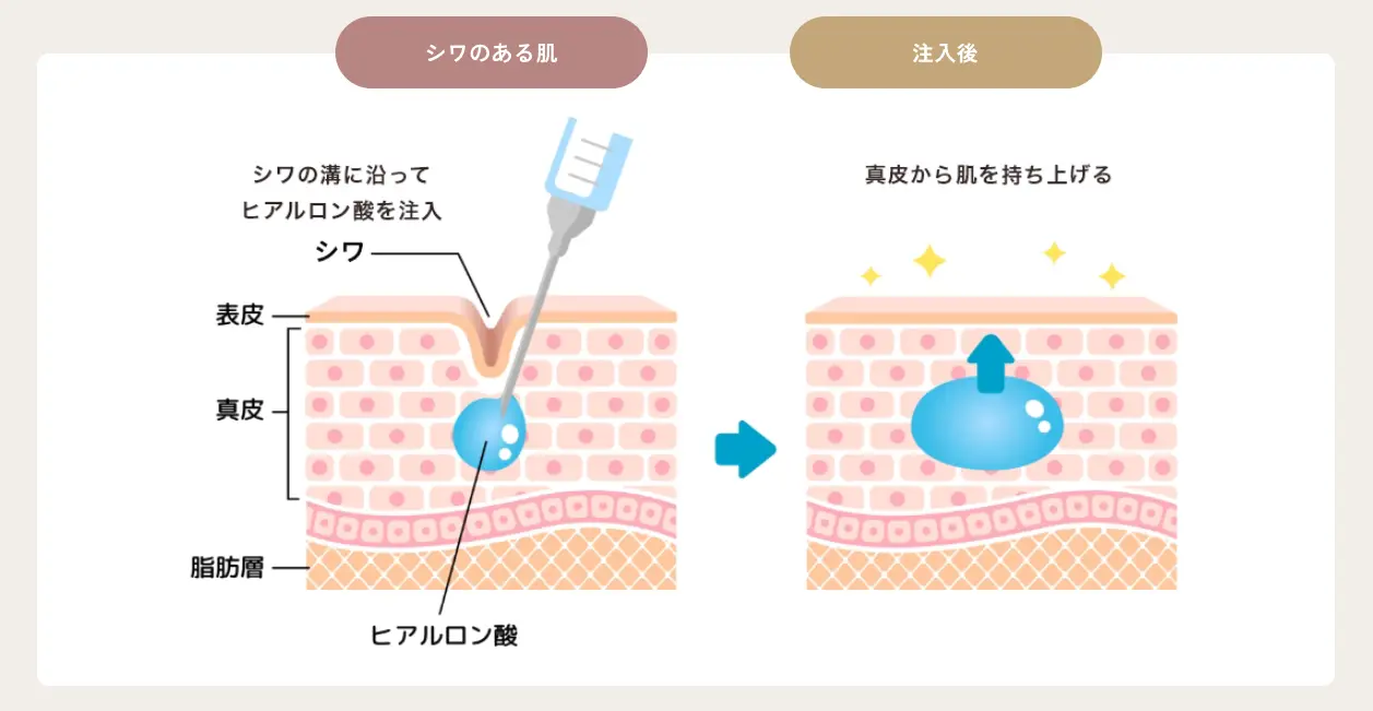 シワへのヒアルロン酸注入