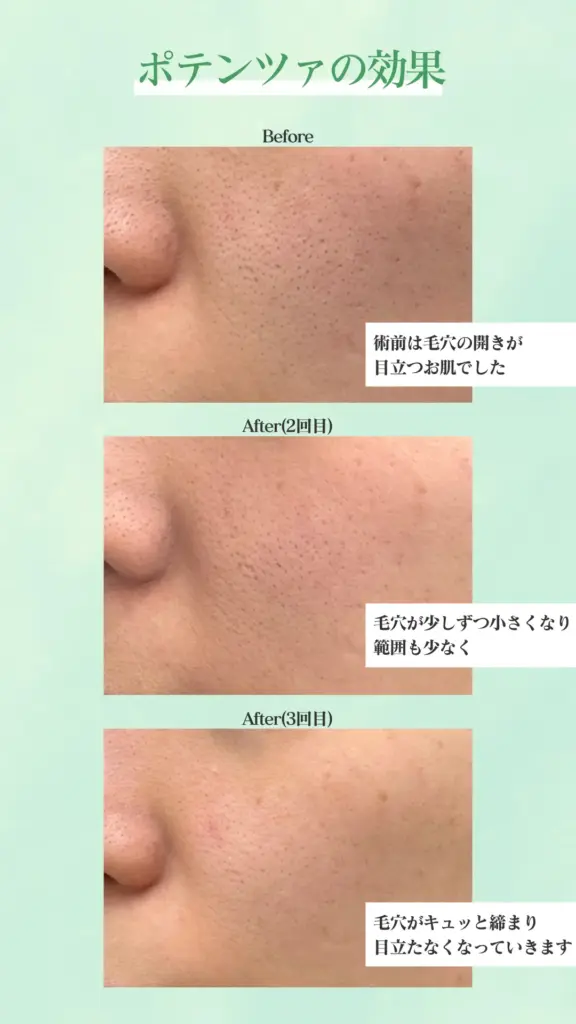 ポテンツァの症例写真