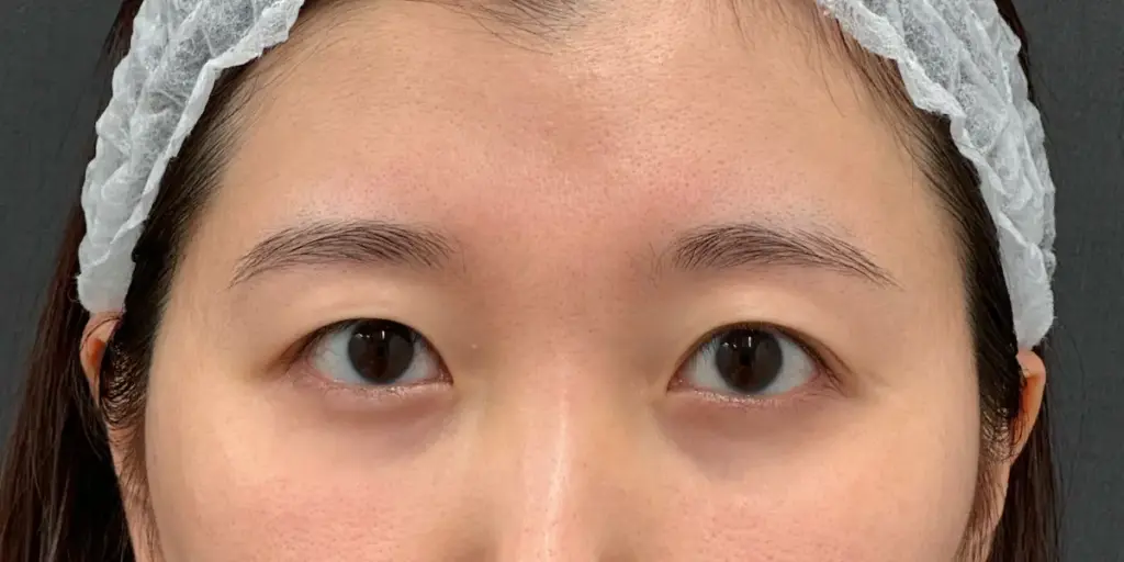 奥二重の画像