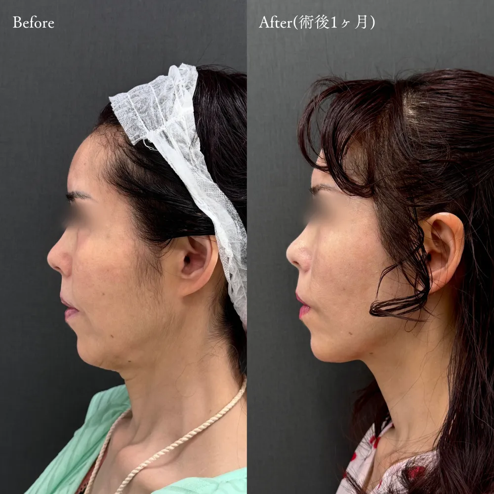 施術内容:糸リフト(アルテミスリフトスタンダード10本)+ヒアルロン酸(製剤名・ボリューマ2cc/ボリフト4cc)