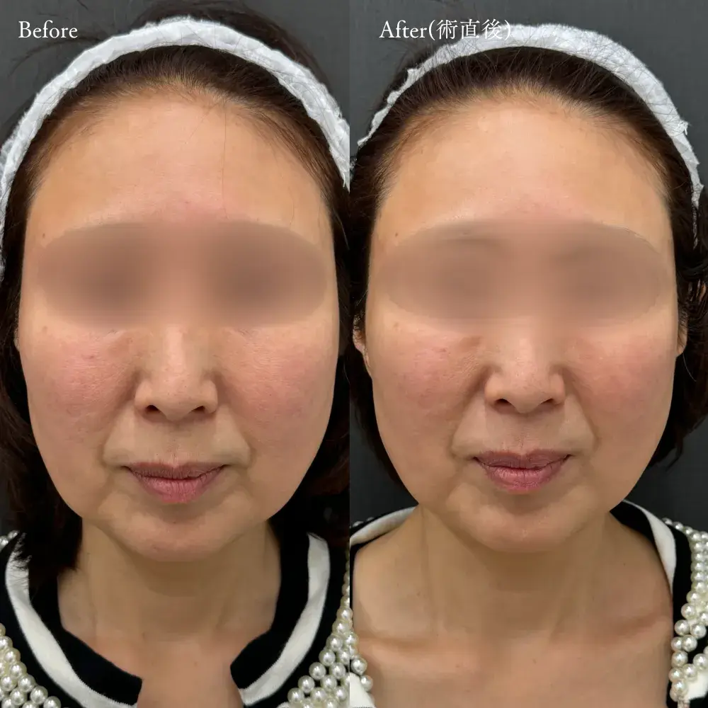 デンシティ 症例(50代 女性)